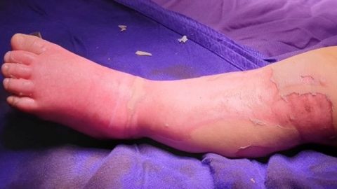 Warning of complications from applying leaves to treat burns