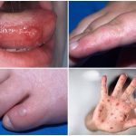 Hand-foot-mouth disease season alert!