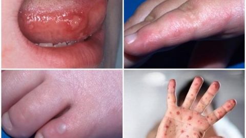 Hand-foot-mouth disease season alert!