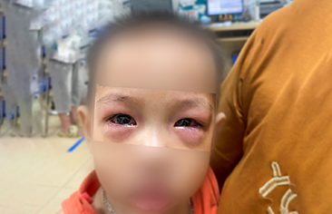 Acute Conjunctivitis (Red Eye) – What Parents Should Know