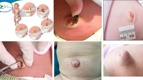 Some unusual signs about the newborn’s umbilical cord